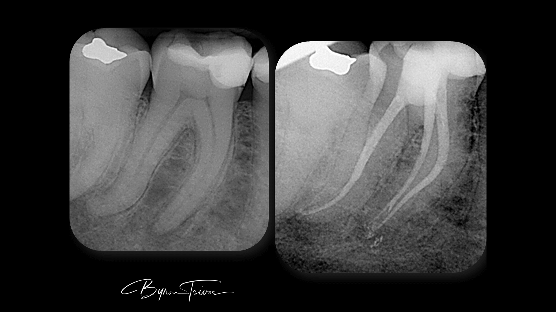 Broken Instrument Removal - Case 6